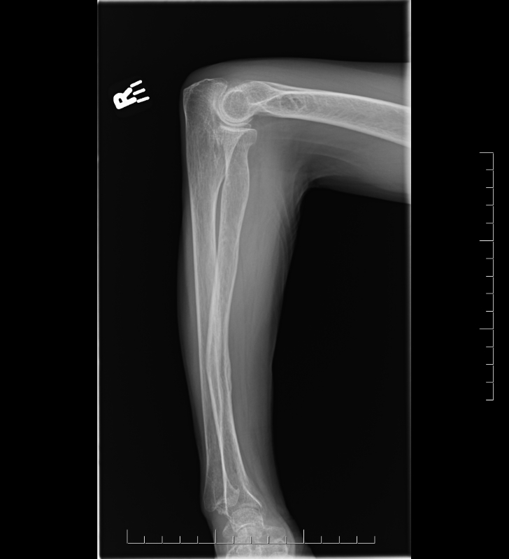 Radial Malunion